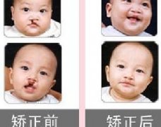 吃兔肉真的會(huì)長(zhǎng)兔唇？為什么會(huì)長(zhǎng)兔唇？